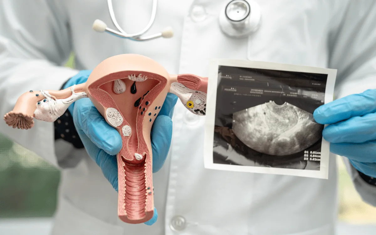 ¿Qué especialista trata los miomas uterinos en Tijuana?